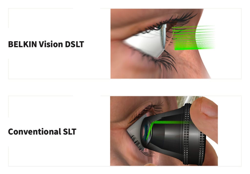 Selective Laser Trabeculoplasty Primary Therapy For Open Angle Glaucoma Review Of Presbyopia