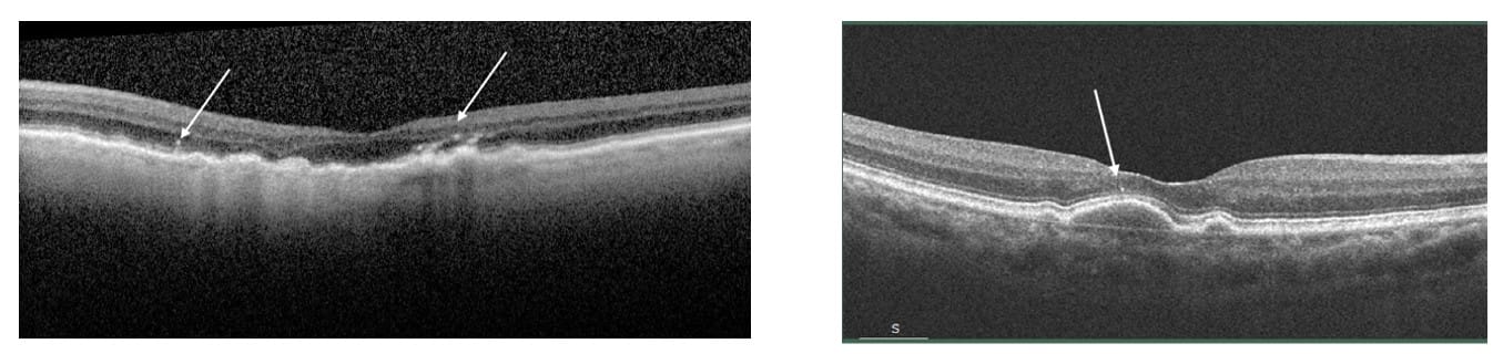 Once You See Them, You Can’t Unsee Them: AMD Biomarkers - Review of ...