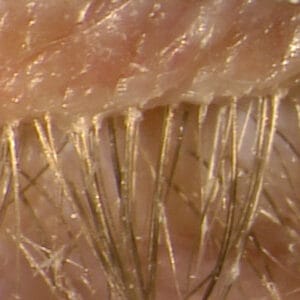 Image of an eyelid with mites