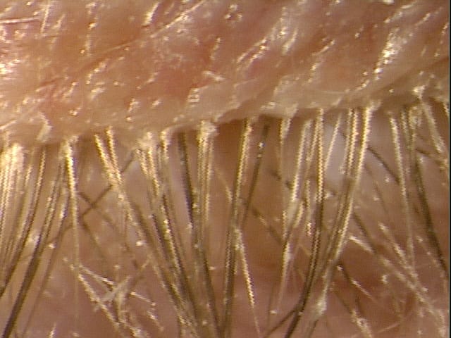Image of an eyelid with mites