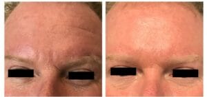 Showing before and after forehead treatment with neurotoxin. 