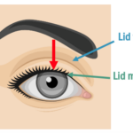 Image demonstrating UEH