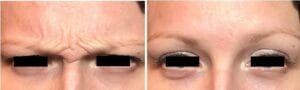 Figure 1: Showing before and after in the glabella region with neurotoxin.