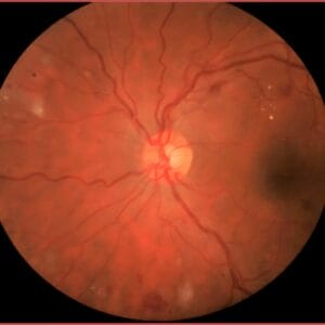 Image showing diabetic retinopathy