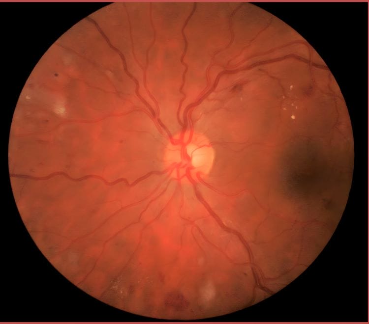 Image showing diabetic retinopathy