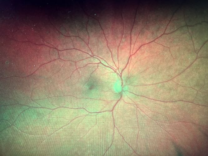 This photo was taken in 2018 of a 55-year-old male who was diagnosed with type 2 diabetes in 2009. There are no hemorrhages from diabetic retinopathy.