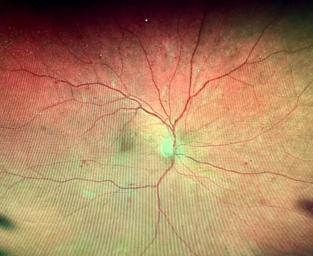This image taken in 2023 shows scattered hemorrhages from diabetic retinopathy.