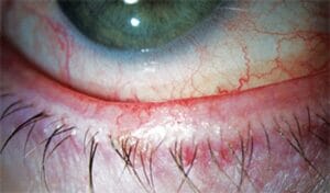 telangiectasia and subsequent ocular rosacea