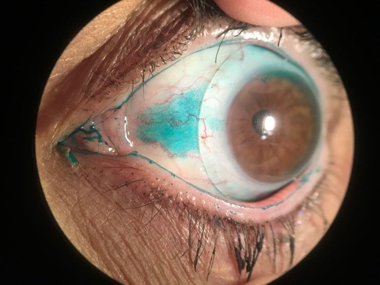 Image of an eye with GPLI article