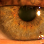 Person with blepharoptosis before using Upneeq eye drops