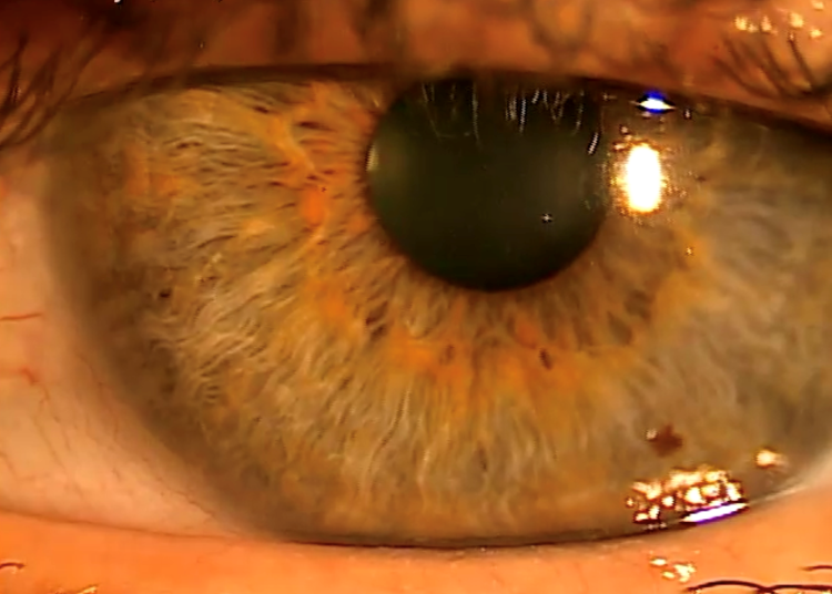 Person with blepharoptosis before using Upneeq eye drops