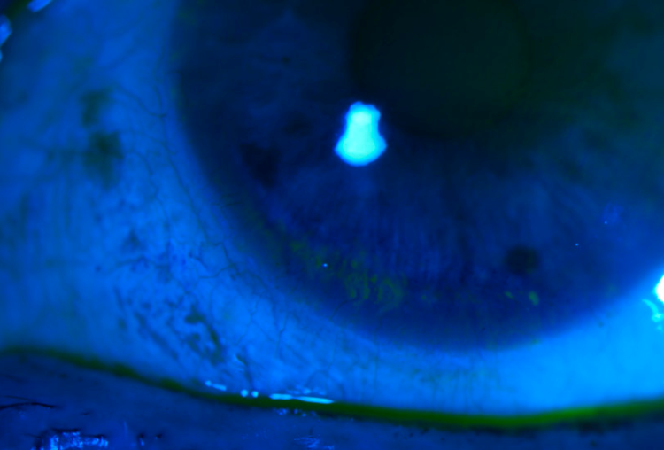 image of corneal and conjunctival staining.