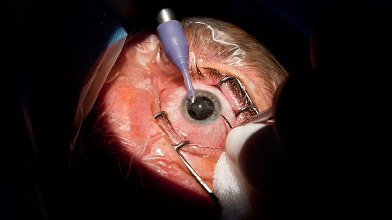 Cataract eye surgery