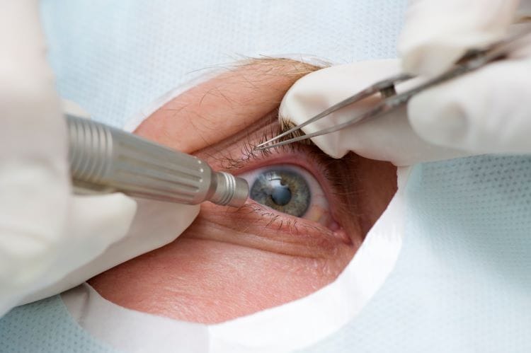 cataract surgery