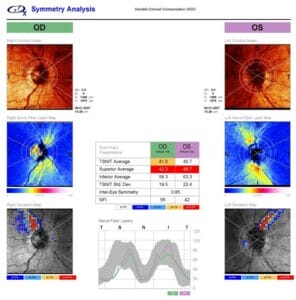 GDx Retinal Nerve Fiber Analyzer printout