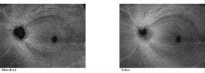 RNFL Optical Texture Analysis (ROTA) Images