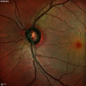 retinal nerve fiber