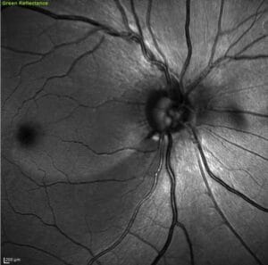 retinal nerve fiber layer photograph