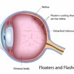 Eye floaters illustration