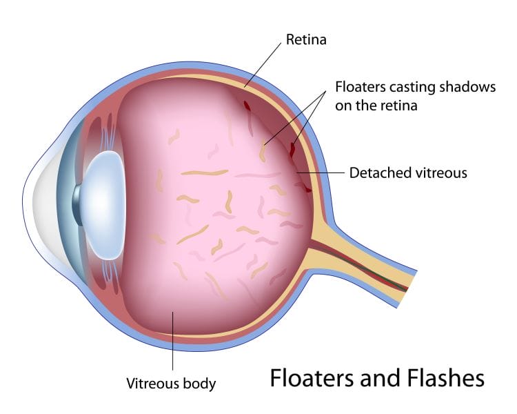 Eye floaters illustration
